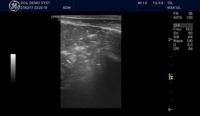 ecografia-pulmonar