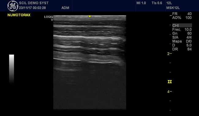 ecografia_pulmonar_numotorax