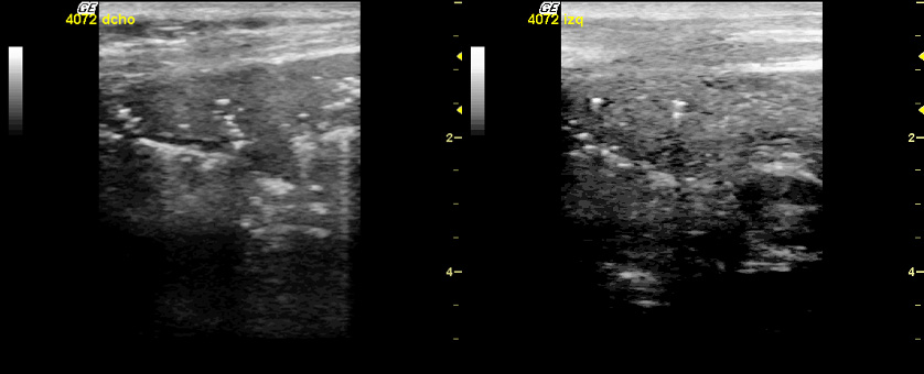 ecografías pulmonares de bronconeumonías del aspecto craneal del lóbulo craneal derecho compatibles con las lesiones producidas por la infección de Mycoplasma Bovis